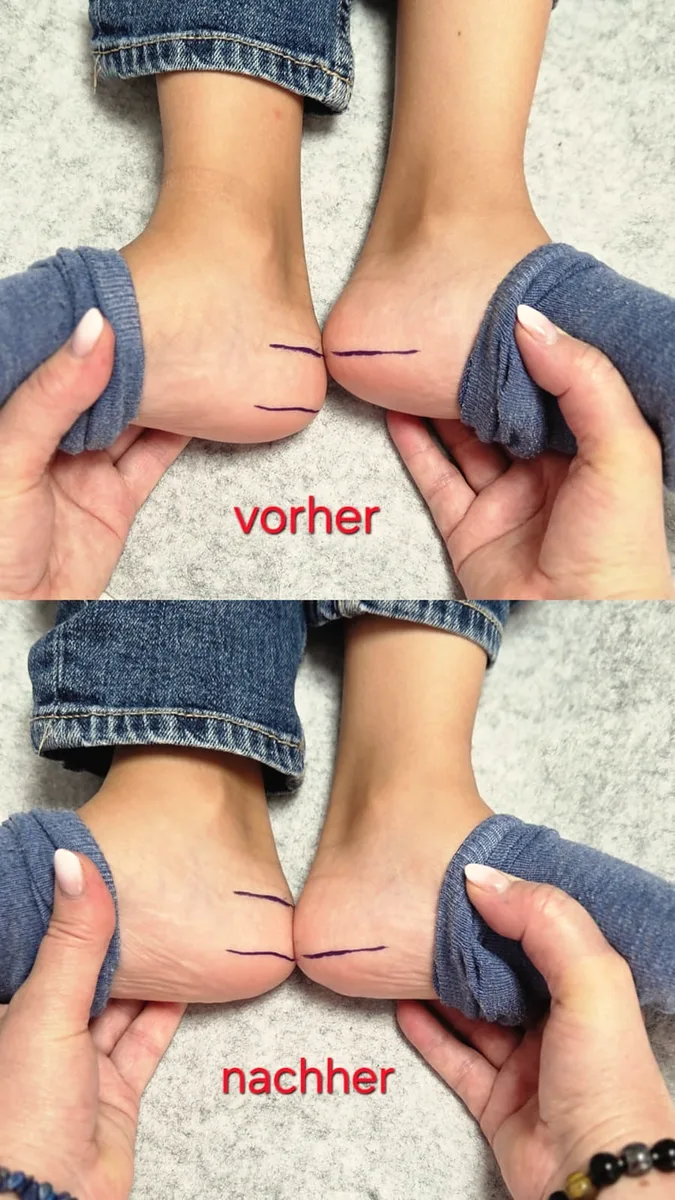 Vorher und nachher: markierte Fersen eines Kindes, Beinlängen gleichen sich an